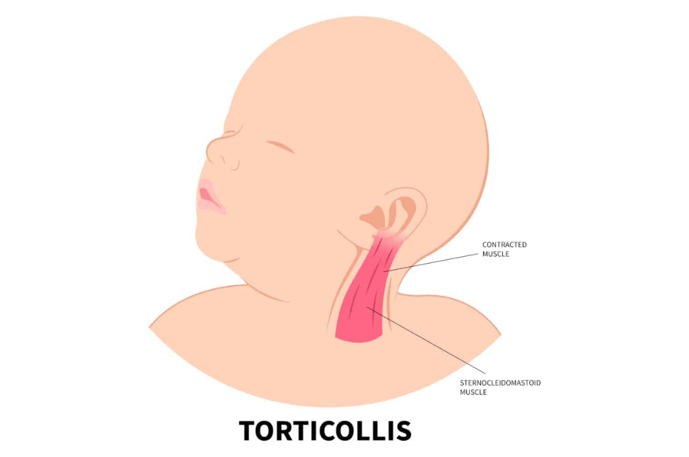 Illustration of a baby with torticollis
