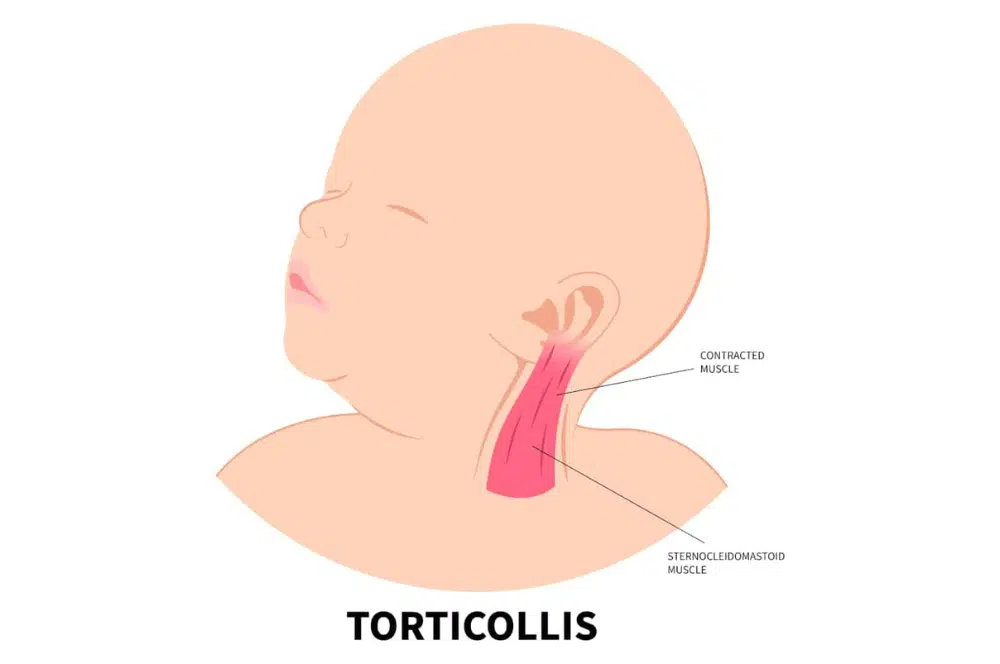 Illustration of a baby with torticollis